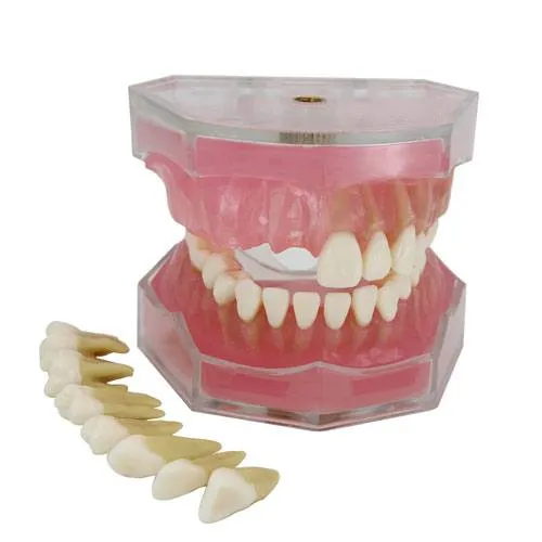 dental implant teeth model